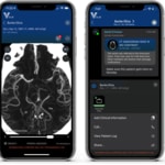 New Study Finds 85% of Aneurysms Identified by Viz™ ANEURYSM had not Been Referred for Neurovascular Review
