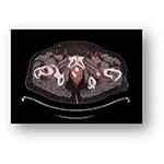 Blue Earth Diagnostics Announces Efficacy and Safety Results from Phase 3 LIGHTHOUSE Trial of Investigational PET Imaging Agent 18F-rhPSMA-7.3 in Newly Diagnosed Prostate Cancer