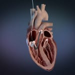 First Patients in the World Treated with Impella RP Flex with SmartAssist