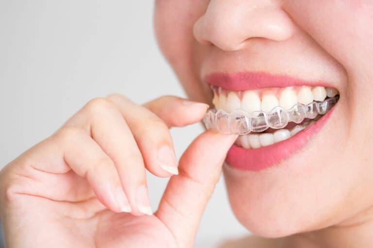 7 Perks of Clear Aligners Straighten Your Teeth Discreetly